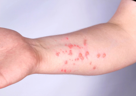 Sobe para 140 número de casos confirmados de Mpox no país em 2026